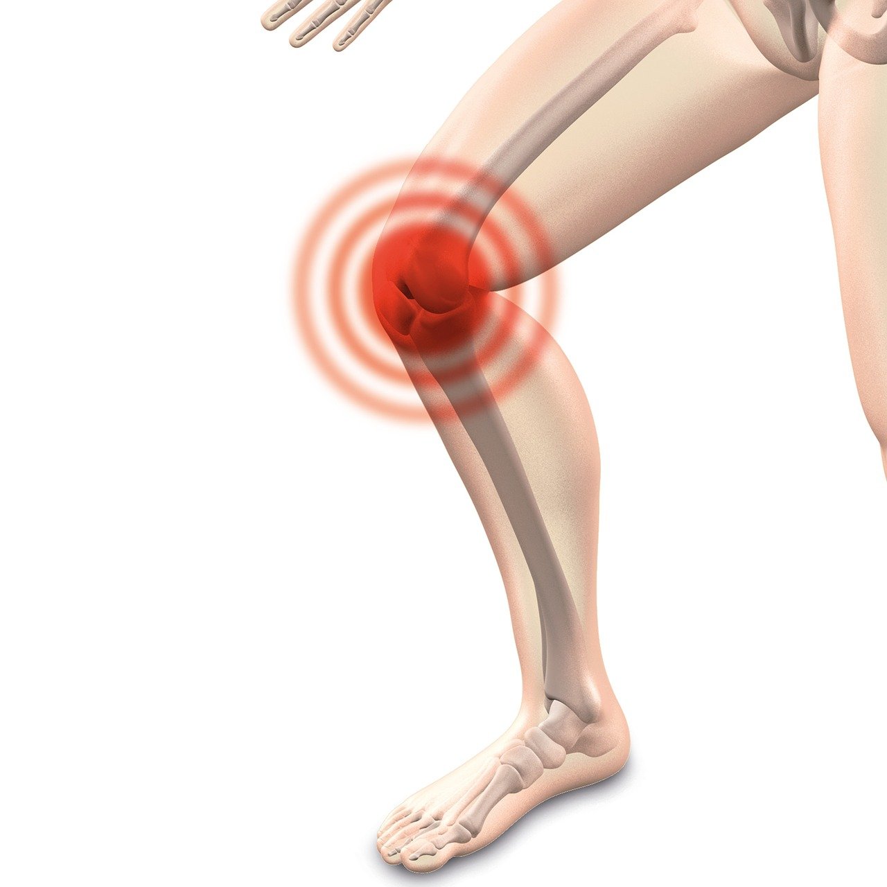 arthrocalman, osteoarthritis, knee